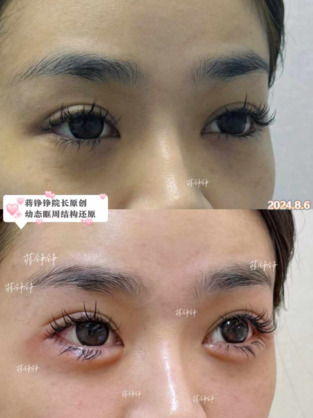 鄭州安中磊醫(yī)生眼部整形技術(shù)優(yōu)勢