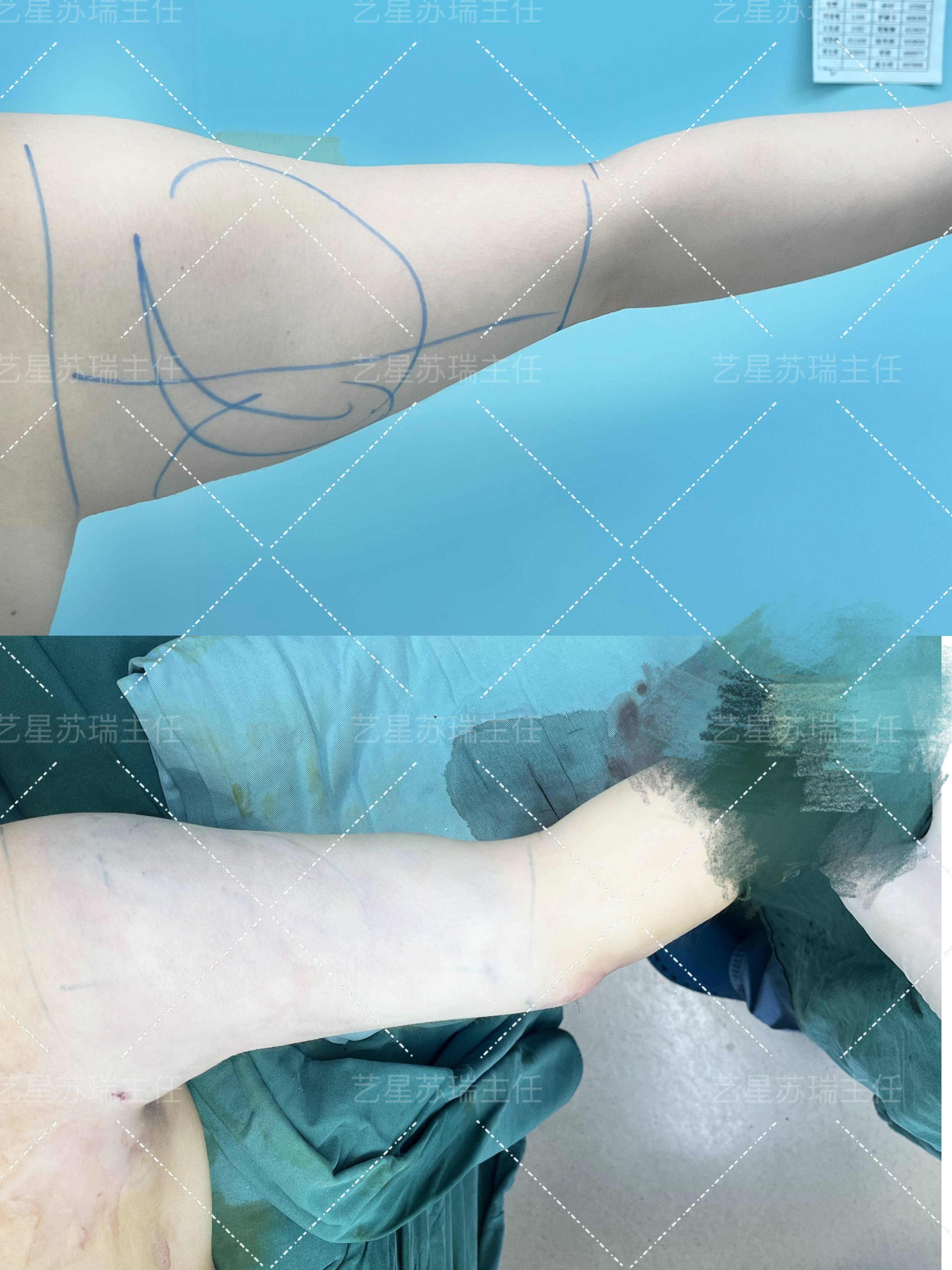 顧云鵬和韓雪峰誰做脖子吸脂更牛？顧擅精致線條，韓重快速恢復(fù)！ 