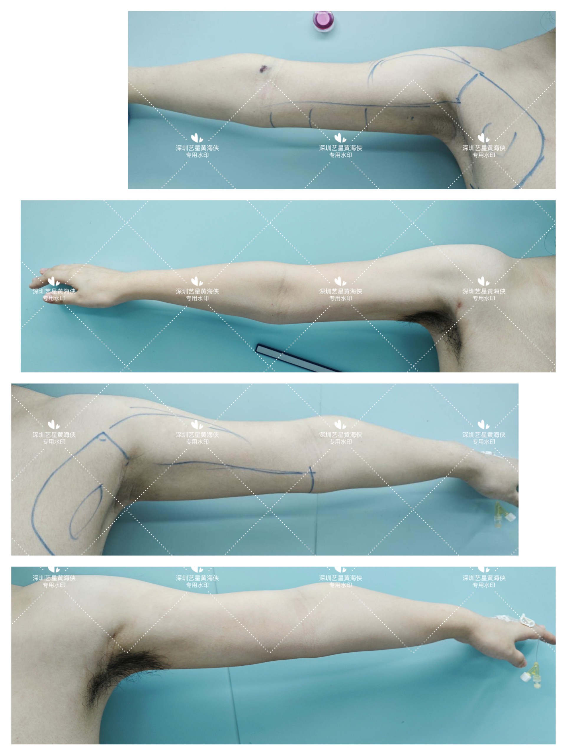 顧云鵬醫(yī)生的脖子吸脂優(yōu)勢