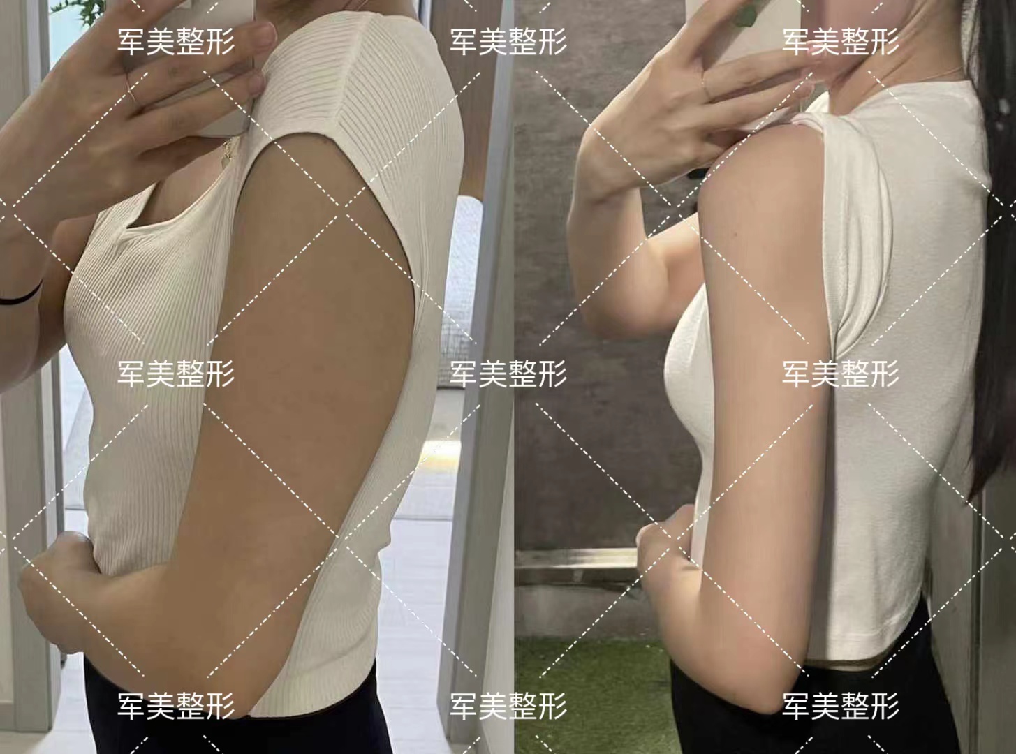 顧云鵬吸脂做得好嗎？他10余年專注吸脂，“筷子腿”塑形效果超棒！ 