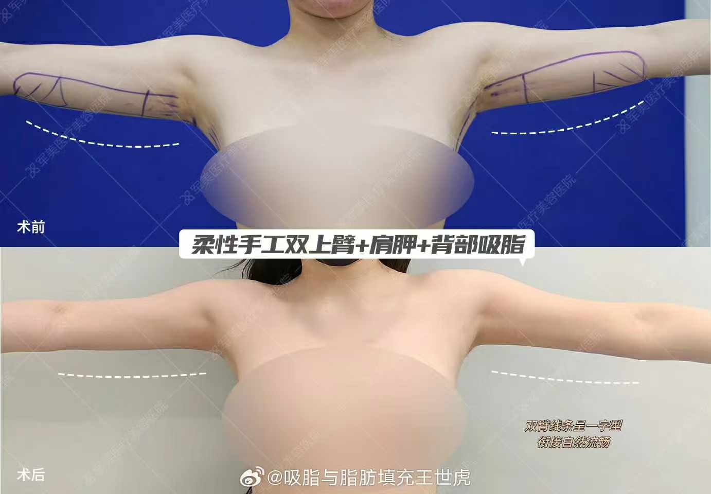 顧云鵬吸脂技術(shù)特點(diǎn)揭秘！