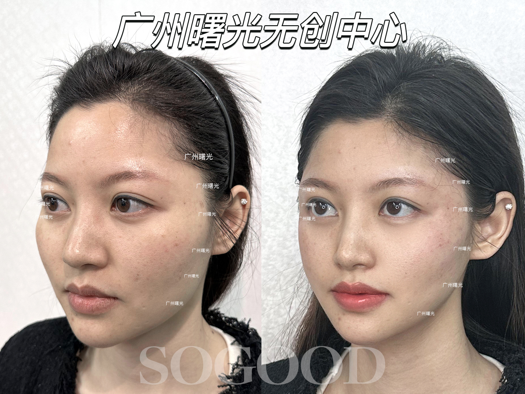 袁強醫(yī)生：MCR拉皮技術超棒