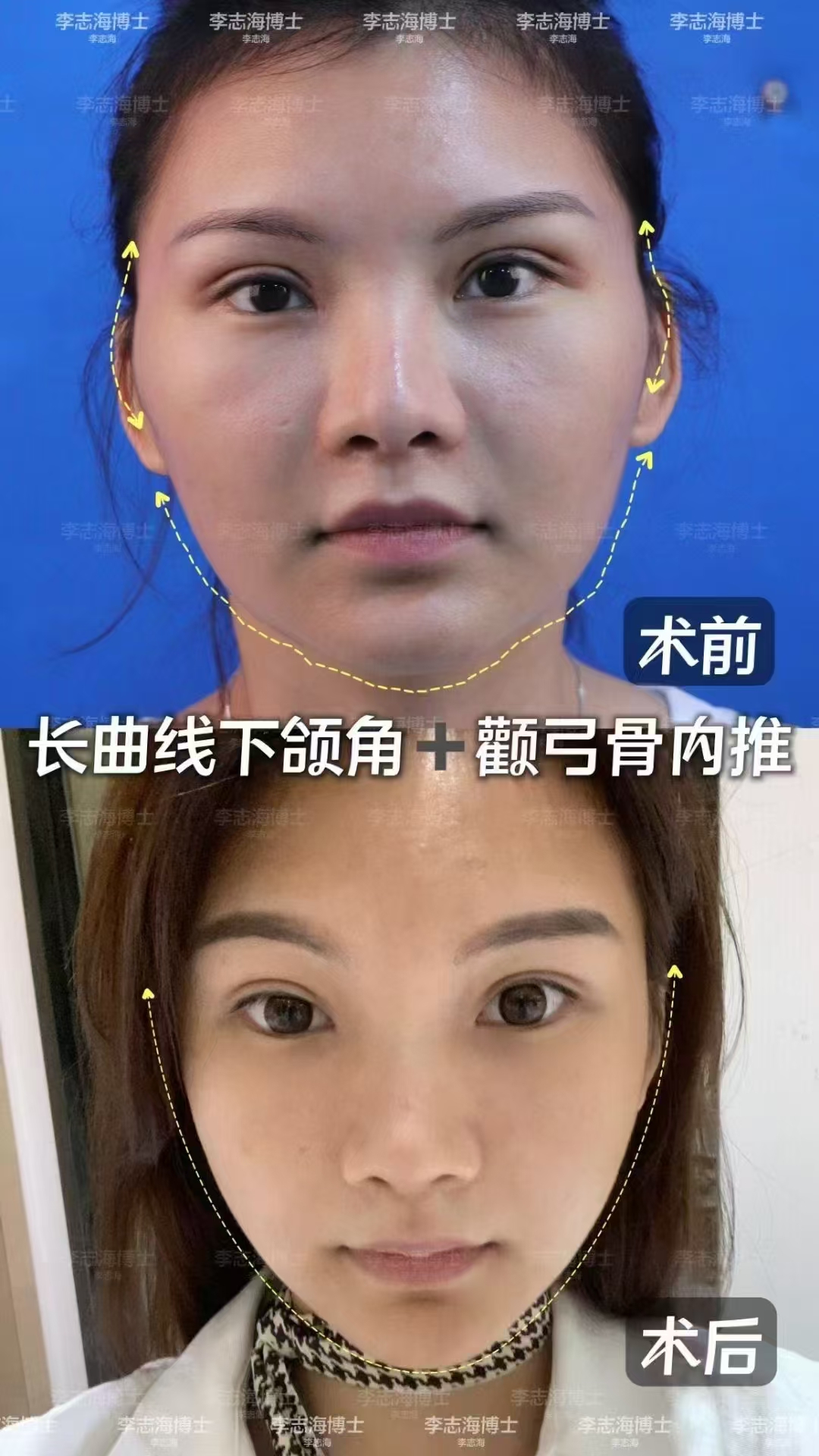 一、杜本軍 醫(yī)生：抗下垂V臉截骨技術(shù)，術(shù)后輪廓緊致流暢