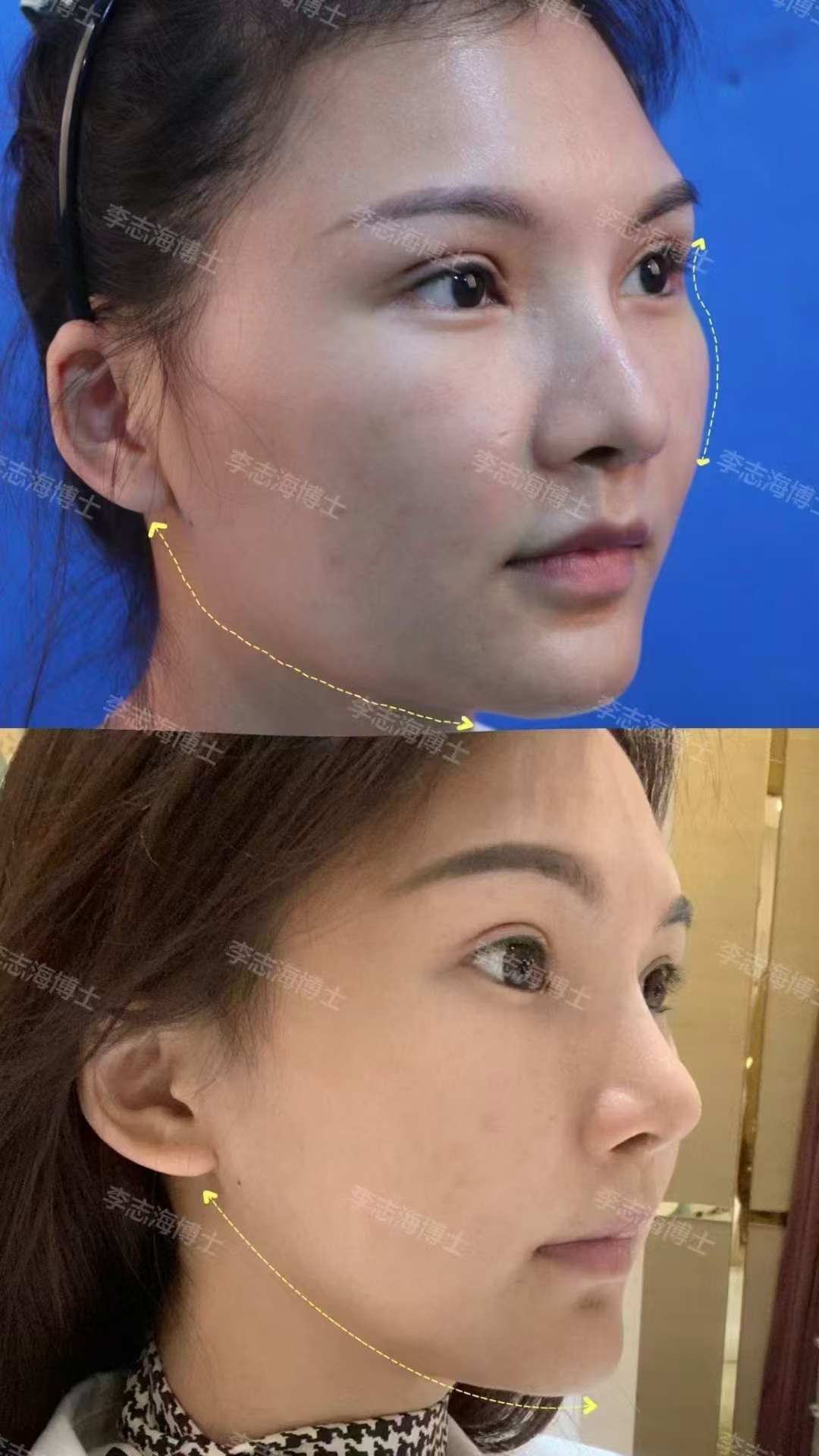 二、柳超醫(yī)生：超長(zhǎng)曲線(xiàn)截骨技術(shù)，打造自然流暢下頜線(xiàn)www.sorencai.cn