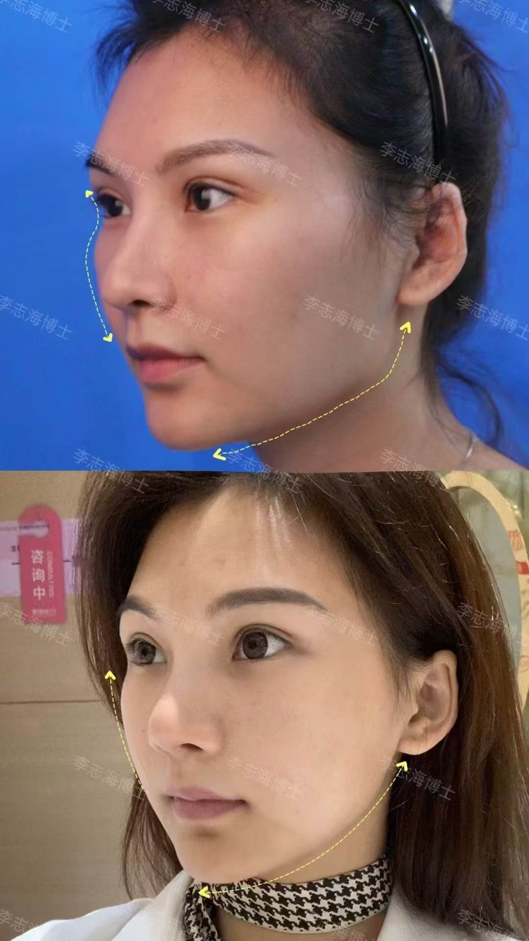 三、何錦泉醫(yī)生：3D導(dǎo)板精細(xì)截骨，數(shù)字化正頜技術(shù)引領(lǐng)者