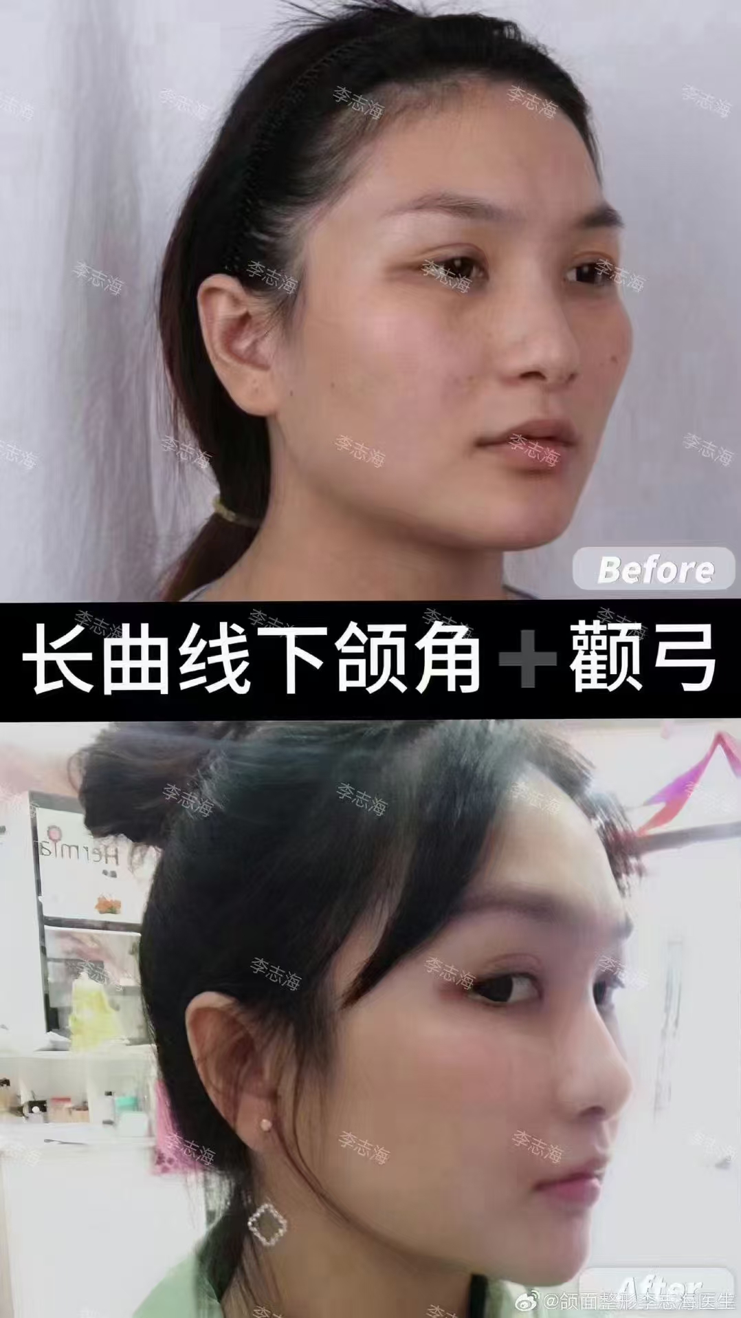 四、廣州下頜角手術(shù)醫(yī)生排名前十名單（2026全新版）