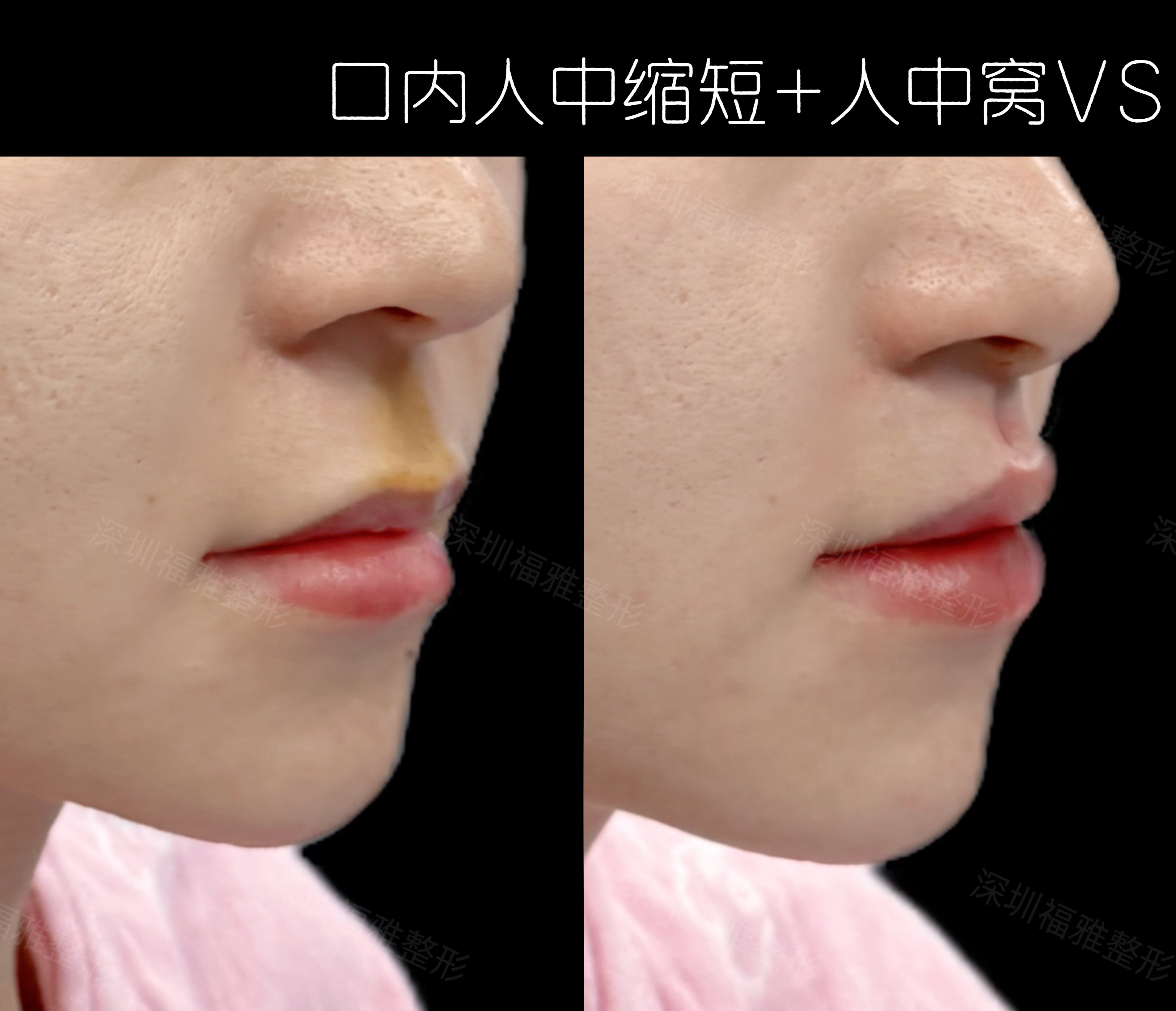 譚拯醫(yī)生人中縮短/鼻綜合手術(shù)預約流程