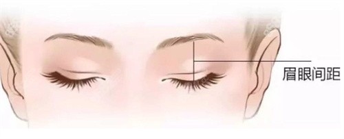 雙眼皮術前設計