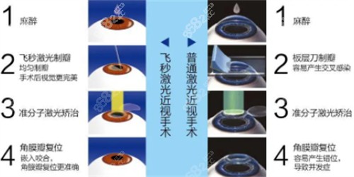 飛秒近視手術(shù)與激光近視手術(shù)的過程區(qū)別圖解