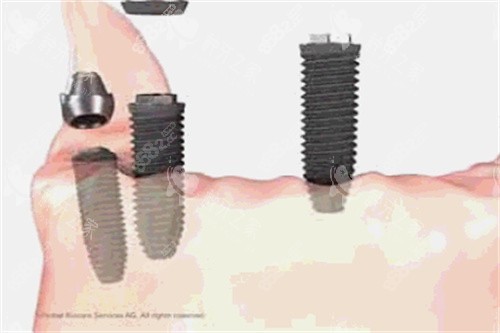 種植牙操作細節(jié)