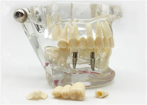 種植牙模具