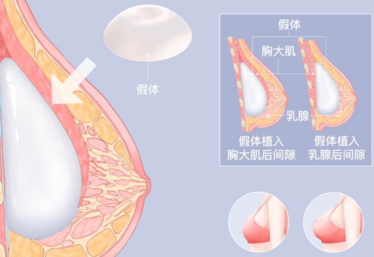 成都熊猛和汪灝隆胸對比分析