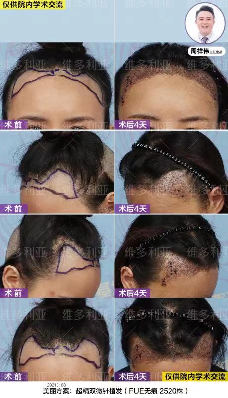 微整注射項(xiàng)目推薦：崔晶瑩醫(yī)生親自操刀，效果立現(xiàn)