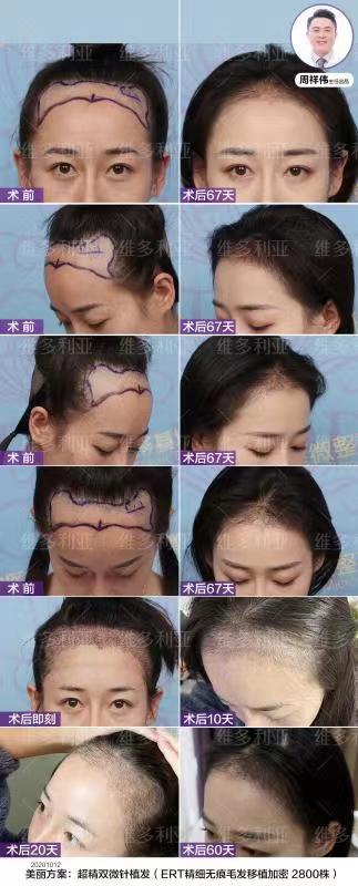 輪廓固定術(shù)：打造不動(dòng)刀的小V臉