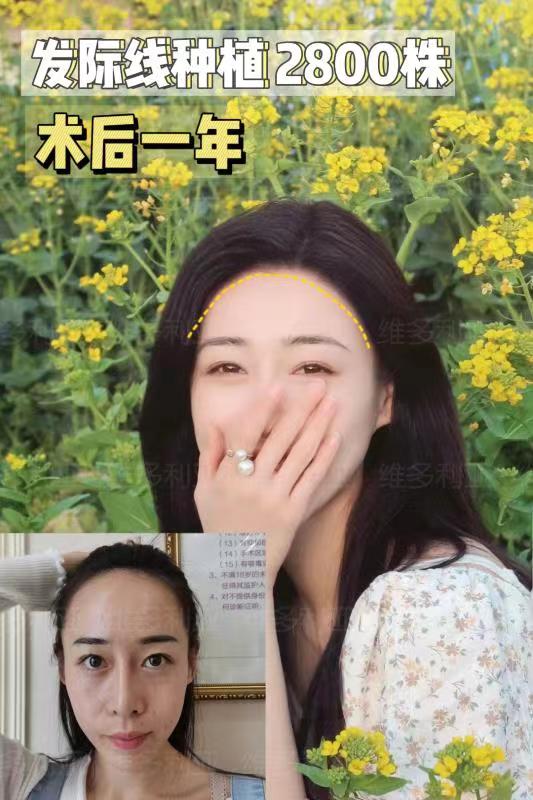 為什么選擇崔晶瑩醫(yī)生做愛(ài)貝芙打鼻子？