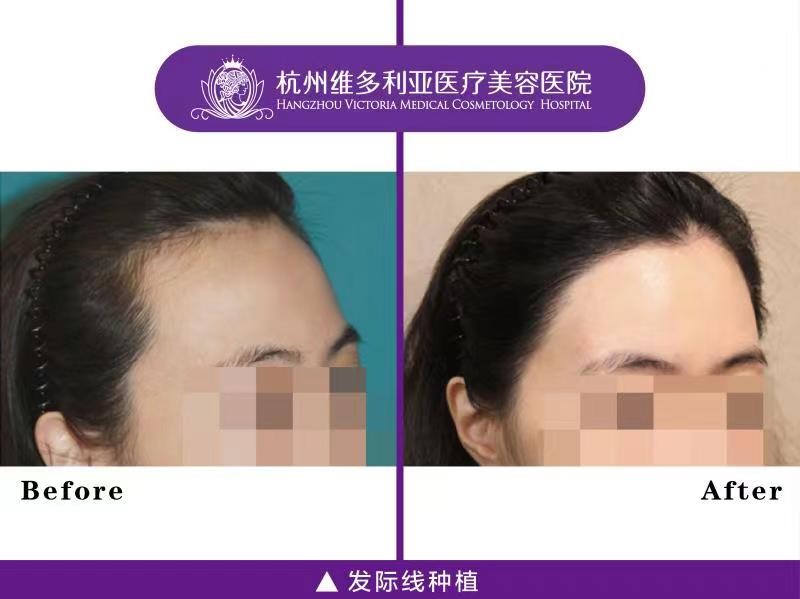 真實(shí)案例分享：術(shù)后效果超出預(yù)期www.sorencai.cn