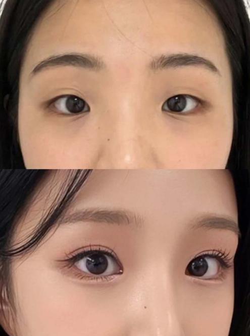 技術(shù)亮點：全切+提肌聯(lián)合術(shù)