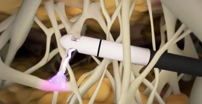 吸脂大咖宋延剛太坑人了？親歷者曬術(shù)后3個月對比圖：凹凸不平是假的！