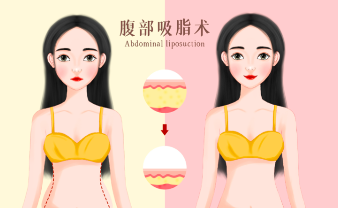 四、廣州鄧晟華醫(yī)生吸脂術(shù)后護(hù)理要點(diǎn)