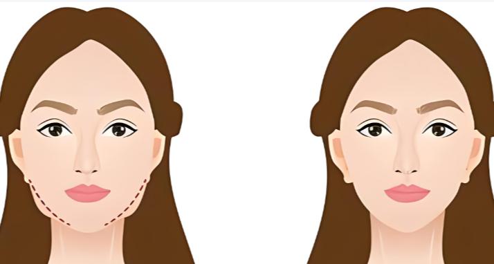 二、上海瑞歐雙下巴吸脂影響的因素