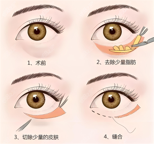 外切祛眼袋術(shù)原理