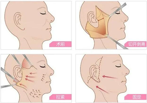 謝宏彬醫(yī)生大拉皮費用 2 萬起，術(shù)后效果能驚艷到啥程度？真人案例揭曉答案！