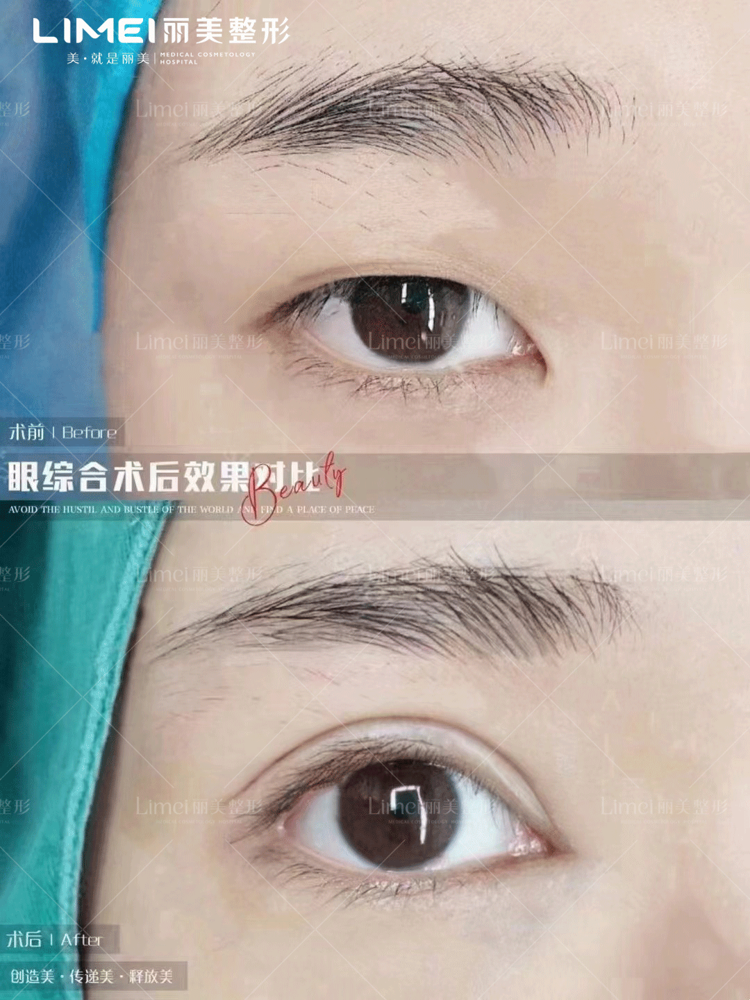 鄭銀龍修復雙眼皮成效咋樣？技術(shù)實力是關(guān)鍵