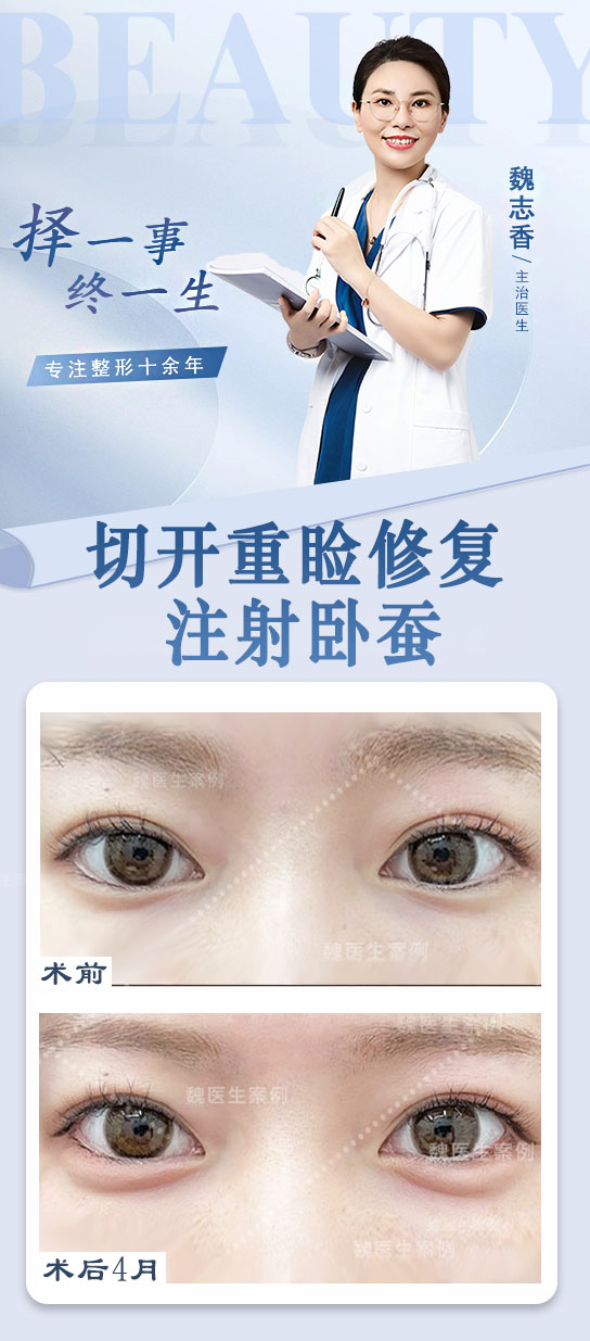 鄭銀龍修復雙眼皮成效咋樣？就診攻略要知曉www.sorencai.cn