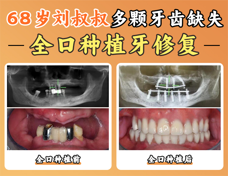 德州人民醫(yī)院種植牙價格一覽（2026年全新）