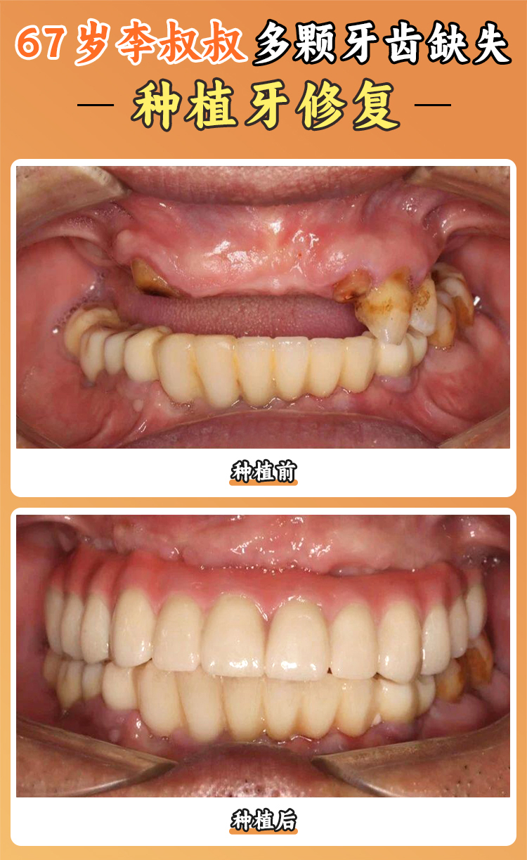 大連九諾口腔哪個大夫種植牙好？大連九諾口腔的預約與口碑