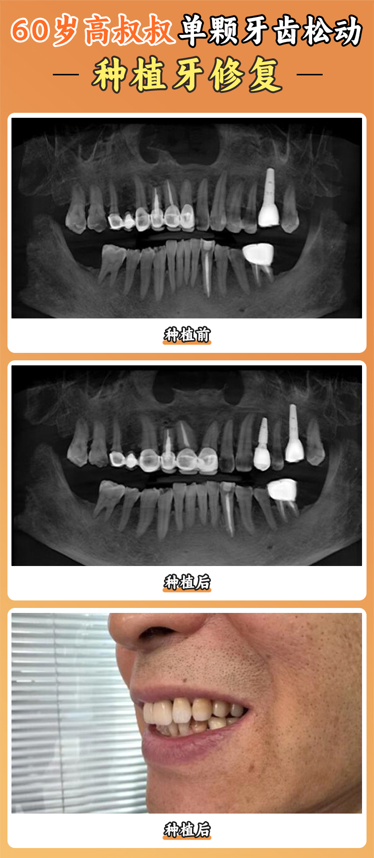德州人民醫(yī)院種植牙技術優(yōu)勢