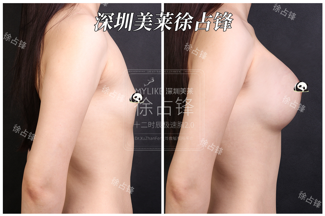 廣州華美李文峰做胸口碑好不好？