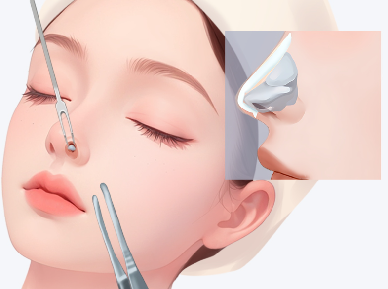 4.2 擅長項目二：鼻修復(fù)，拯救失敗隆鼻，還原自然美鼻www.sorencai.cn