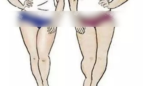 大腿吸脂手術(shù)術(shù)前肉肉圖