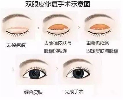 雙眼皮修復(fù)示意圖