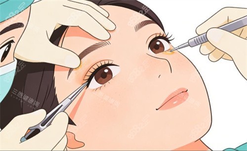 雙眼皮修復(fù)卡通動(dòng)畫圖
