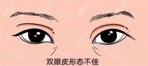 雙眼皮修復(fù)示圖