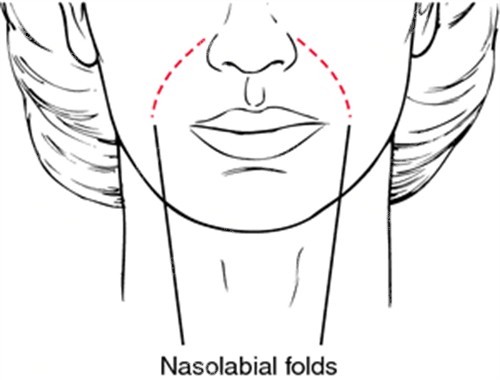 鼻基底凹陷導(dǎo)致法令紋
