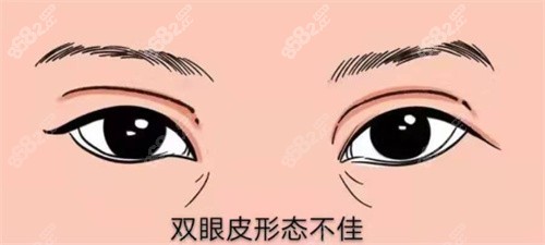 雙眼皮修復(fù)示圖