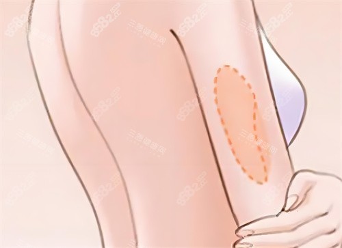 手臂吸脂卡通圖片