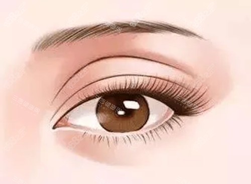 雙眼皮修復(fù)卡通示意圖