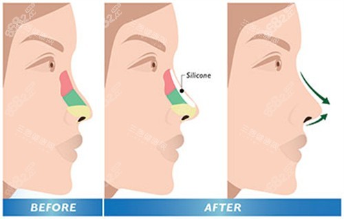 鼻整形前后對比 (2)