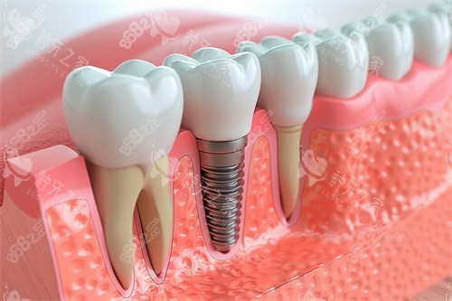 種植牙與正常牙齒模型對(duì)比漫畫(huà)圖