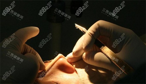 隆鼻整形細(xì)節(jié)圖