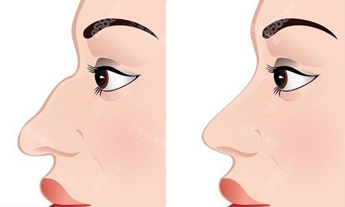 廣州曙光蔣思軍做鼻子怎么樣？個(gè)人簡(jiǎn)介+技術(shù)優(yōu)勢(shì)+價(jià)格參考+術(shù)后評(píng)價(jià)解析