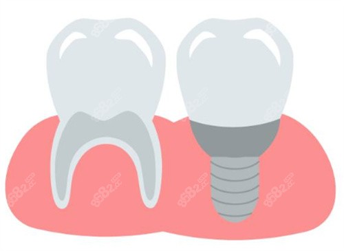 種植牙和牙齒圖