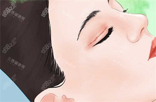 需要雙眼皮修復(fù)的眼睛