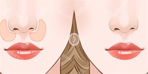 鼻基底填充對(duì)比