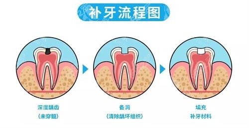 補(bǔ)牙的流程