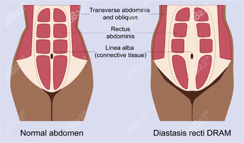 腹壁成形改善肌肉